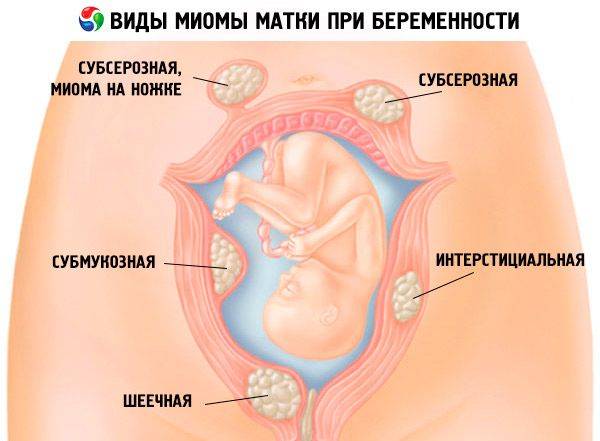 Миома матки и беременность. весомый повод обратиться к квалифицированному акушеру-гинекологу