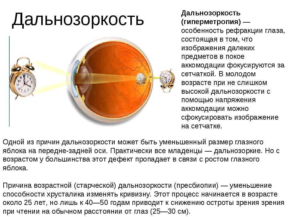 Астигматизм у детей - детский медицинский центр федорова