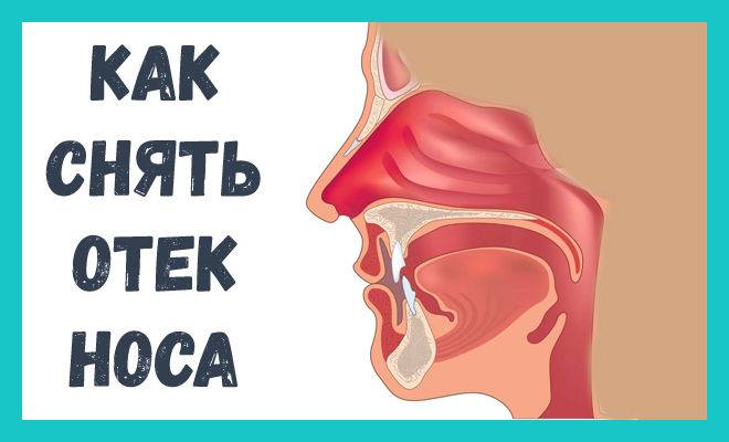 Лечение заложенности носа у беременных (ринит беременных)