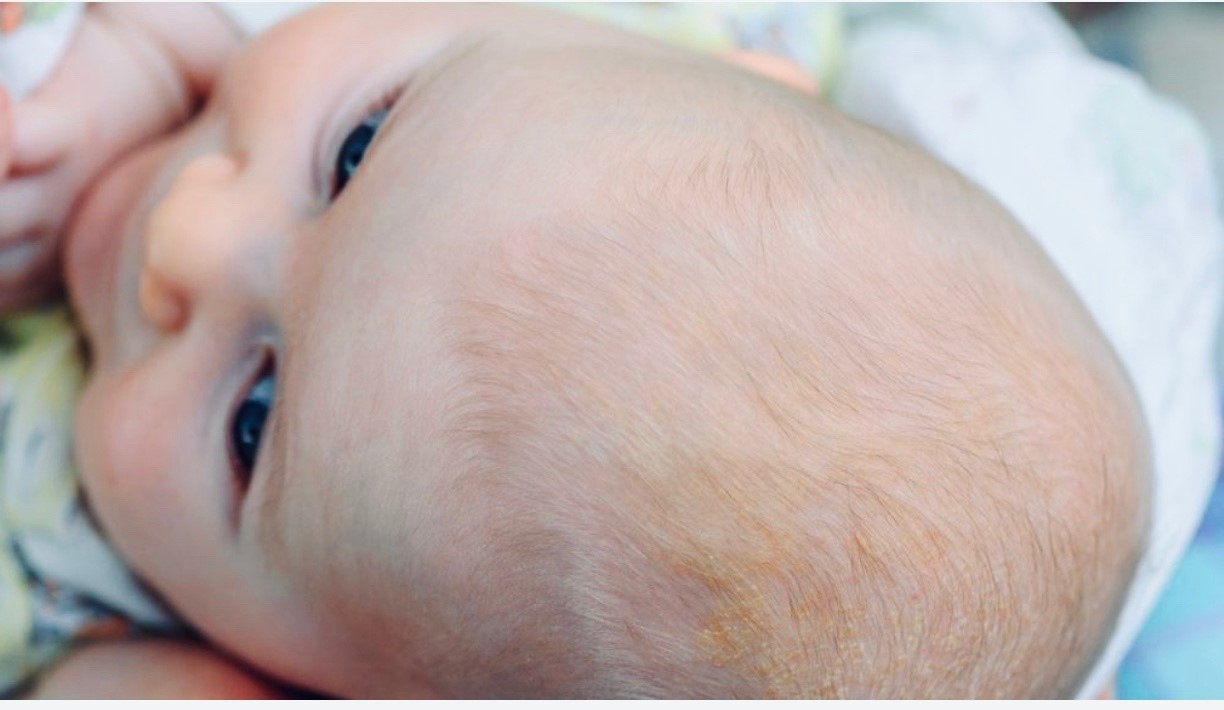 Почему у новорожденного может быть. Себорейный дерматит на коже у грудничка. Гнейс атопический дерматит.