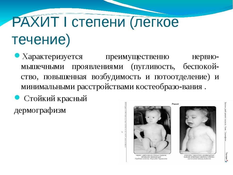Рахит у грудничков (детей до года): признаки и симптомы рахита, лечение, профилактика (витамины), последствия рахита