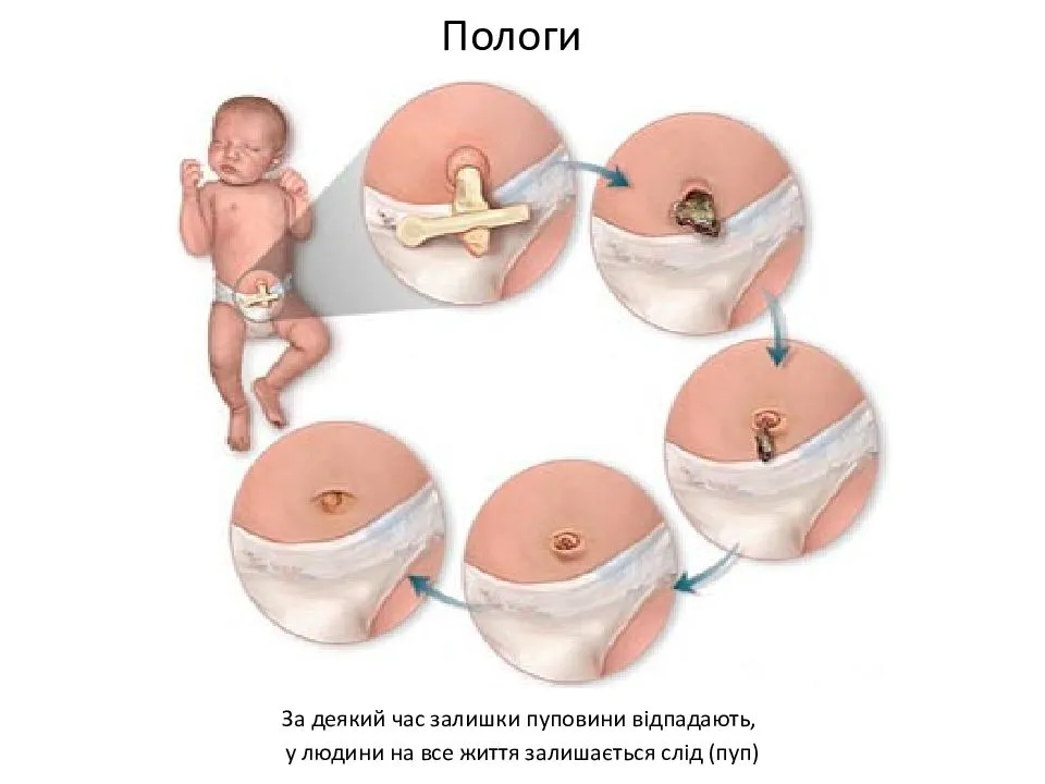 Почему мокнет и сочится пупок у новорожденного ребенка или грудничка: что с этим делать