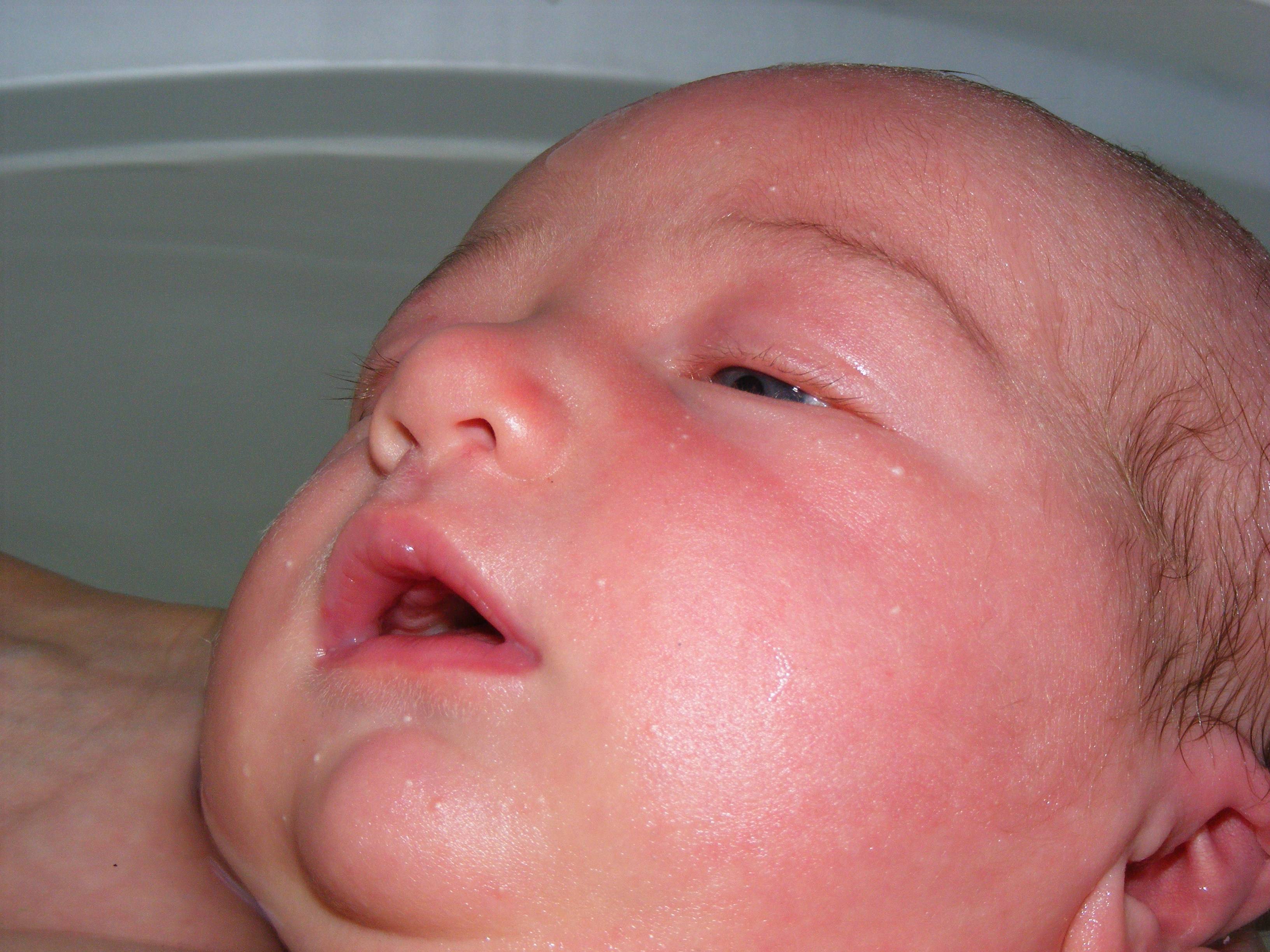 Молочница у детей во рту. как выглядит и чем лечить