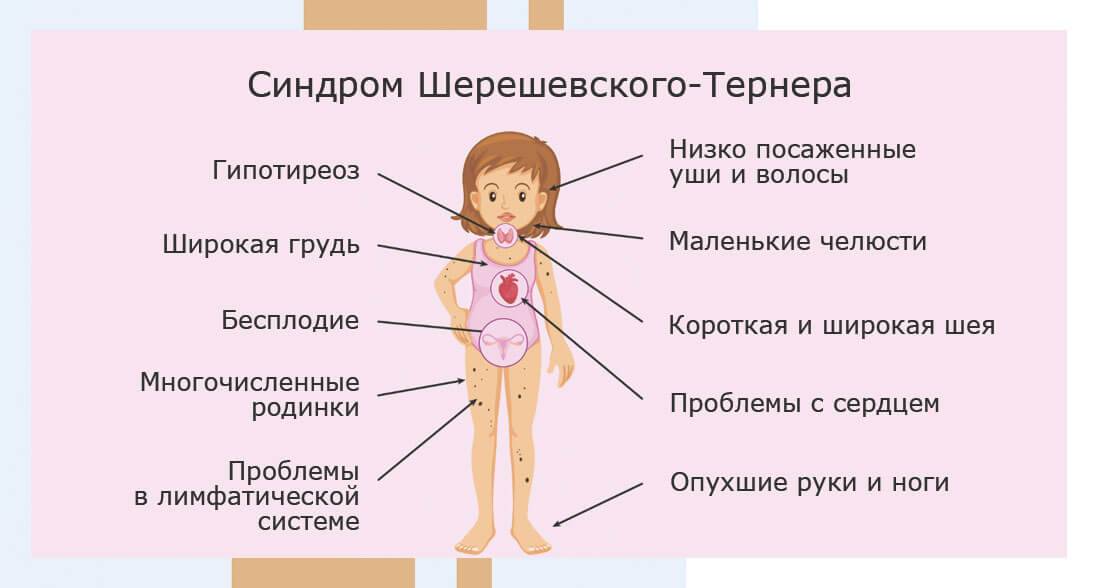 Домашние дети - синдром шерешевского-тернера