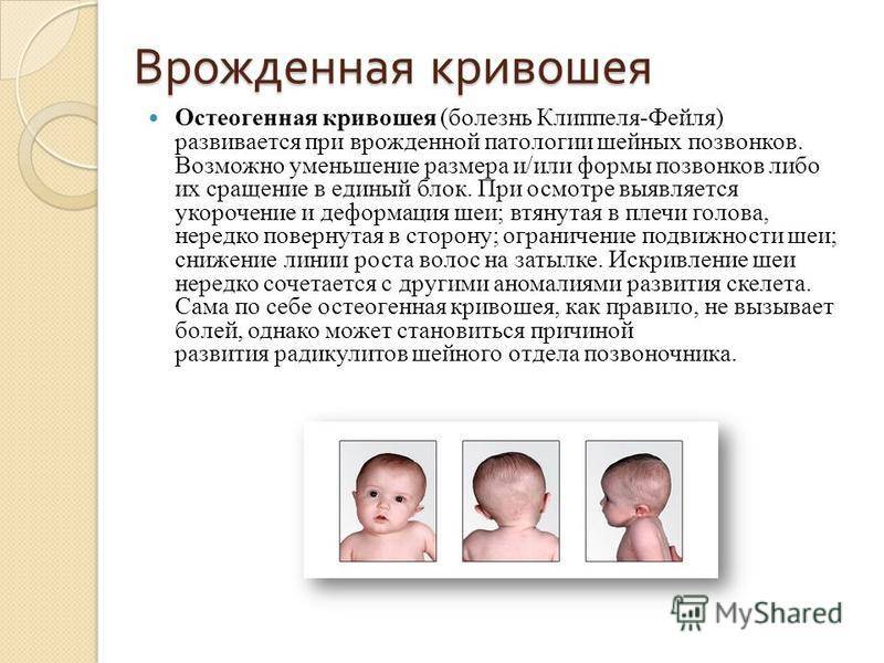Кривошея у новорожденных ????: признаки, фото, массаж и лечение (комаровский)