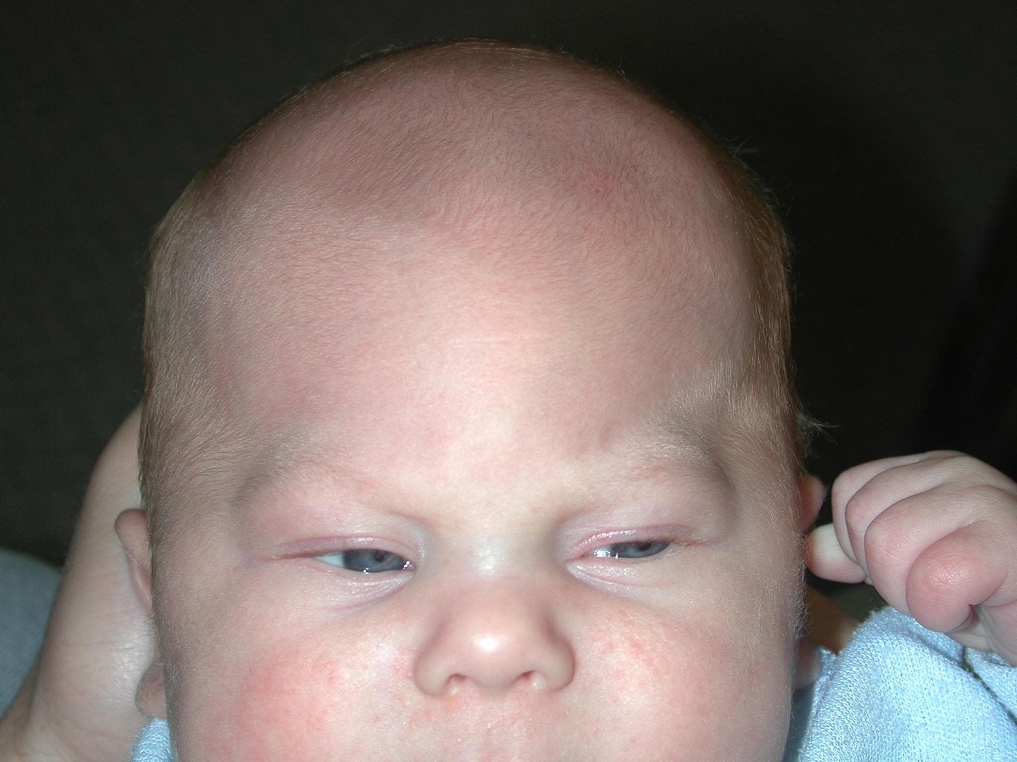Родничок рано. Краниосиностоз тригоноцефалия у детей. Швы черепа краниосиностоз. Краниосиностоз метопический шов у ребенка. Первичный краниостеноз.