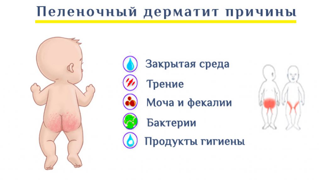 Опрелости у детей: причины, симптомы, лечение