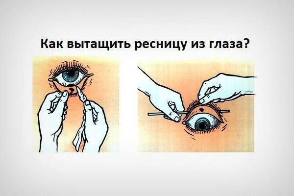 Как убрать волос из глаза у новорожденного - актуальные вопросы  - каталог статей - женское здоровье и гинекология