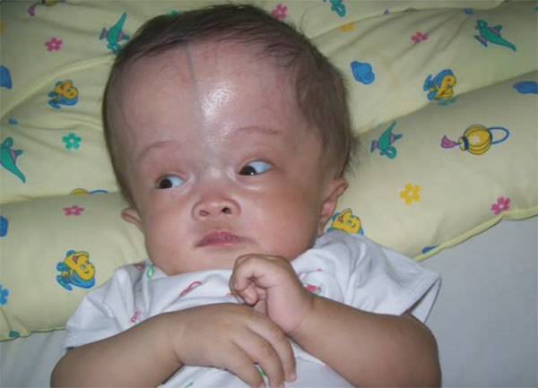 Увеличение окружности головы (макроцефалия) у ребенка: причины, проявление, диагностика, лечение