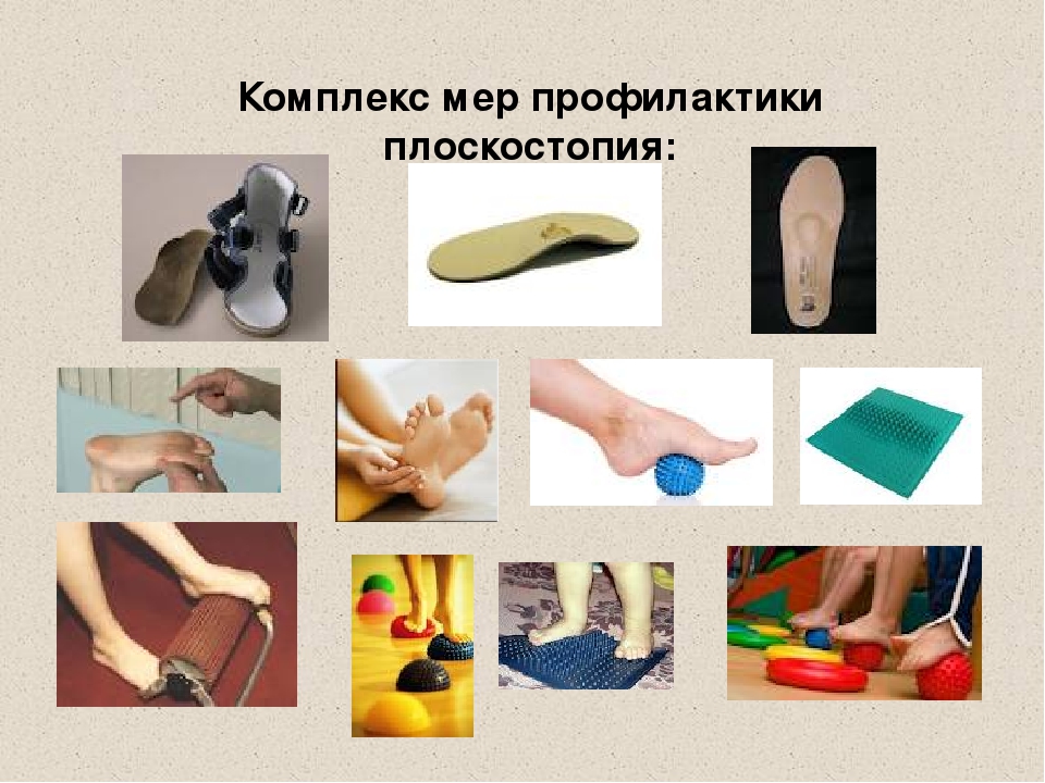 Лечения плоскостопие у детей в домашних условиях: методы и советы