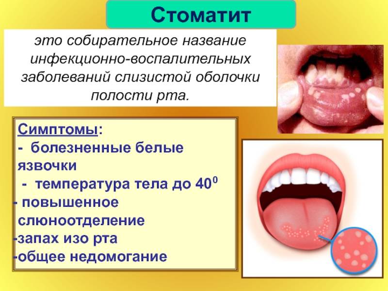 Кандидоз полости рта у детей: причины, лечение