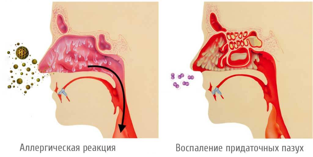Насморк у грудного ребенка: что делать?