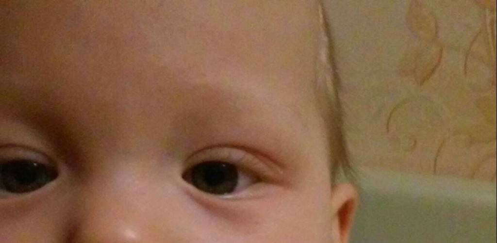 Мешки под глазами у ребенка: причины и лечение - "здоровое око"