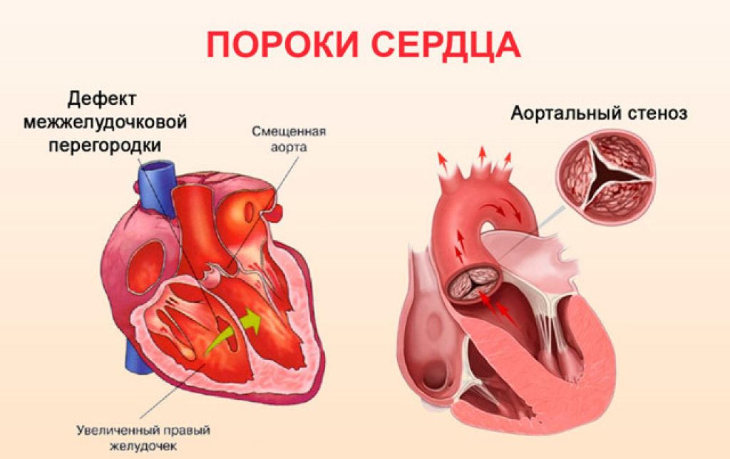 Порок сердца у новорожденных: признаки и симптомы
