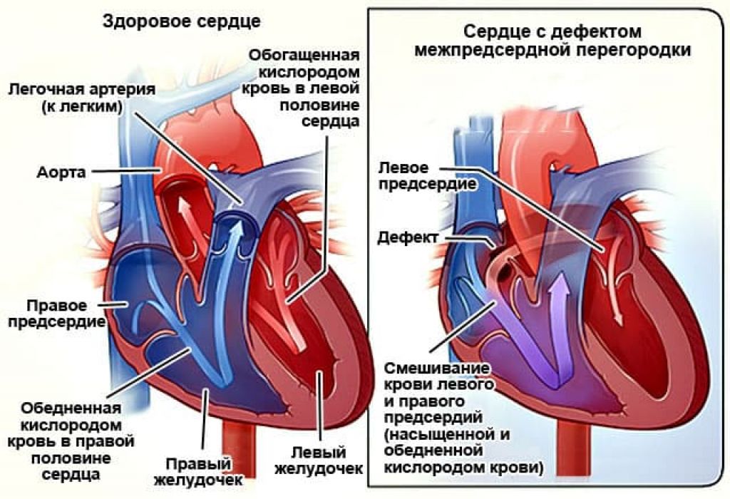 Что такое открытое овальное окно в сердце у ребенка – виды и признаки аномалии межпредсердной перегородки у новорожденного