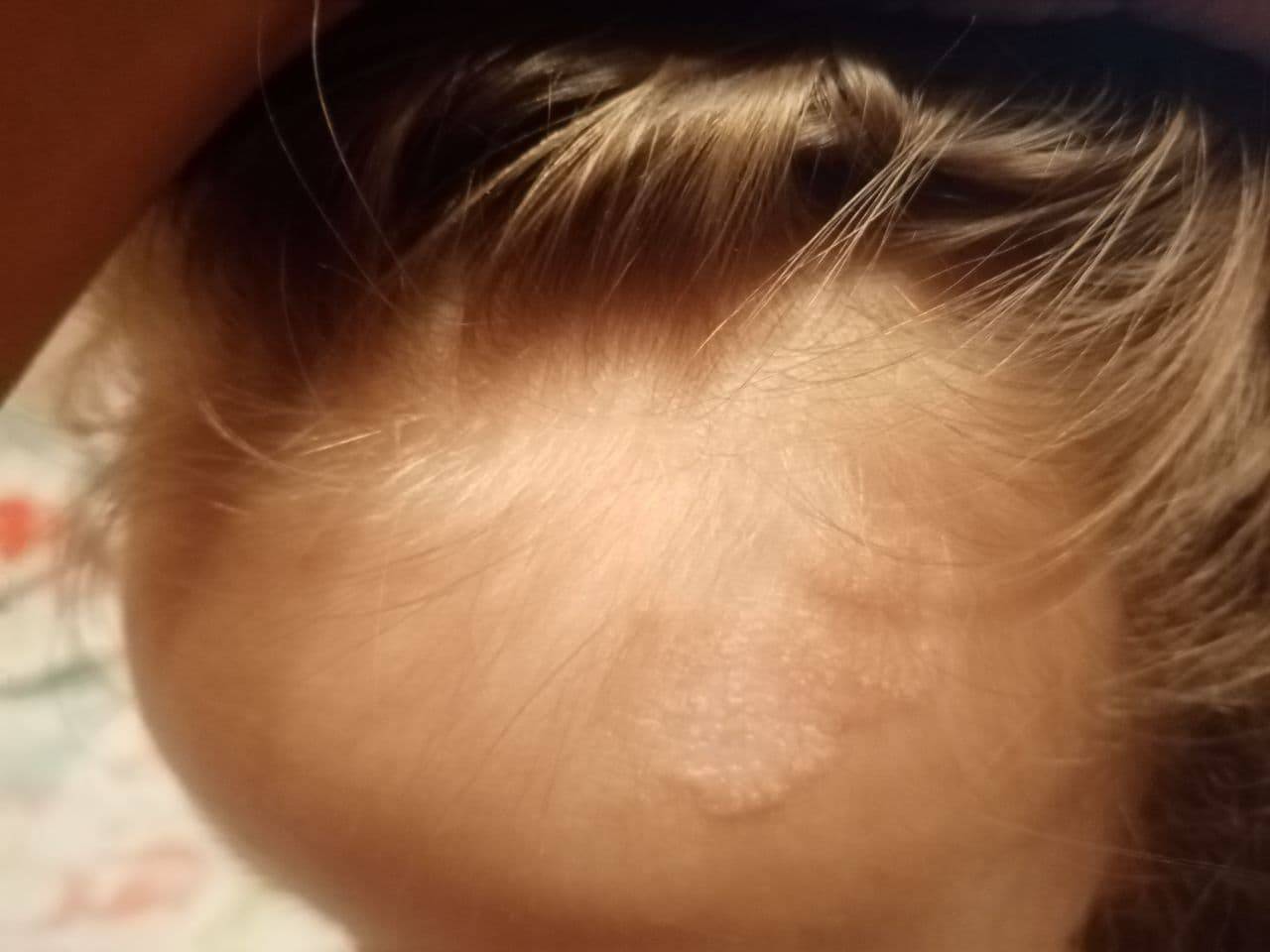 Мелкие водянистые пузырьки на коже у ребенка фото с описанием