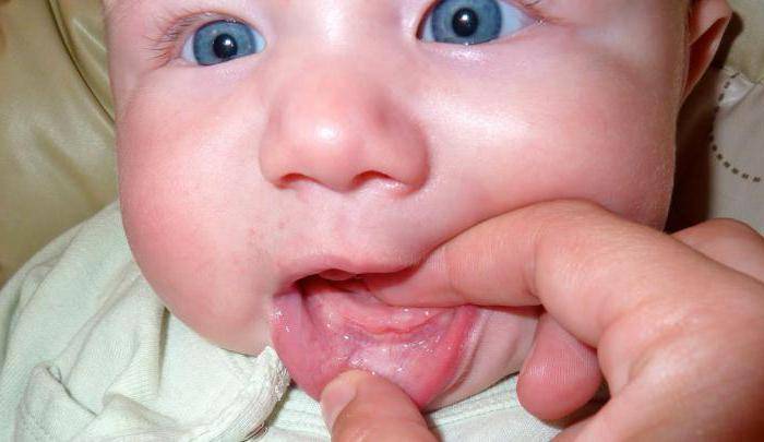 Молочница во рту у грудничка ???? и ребенка от года: лечение и симптомы с фото