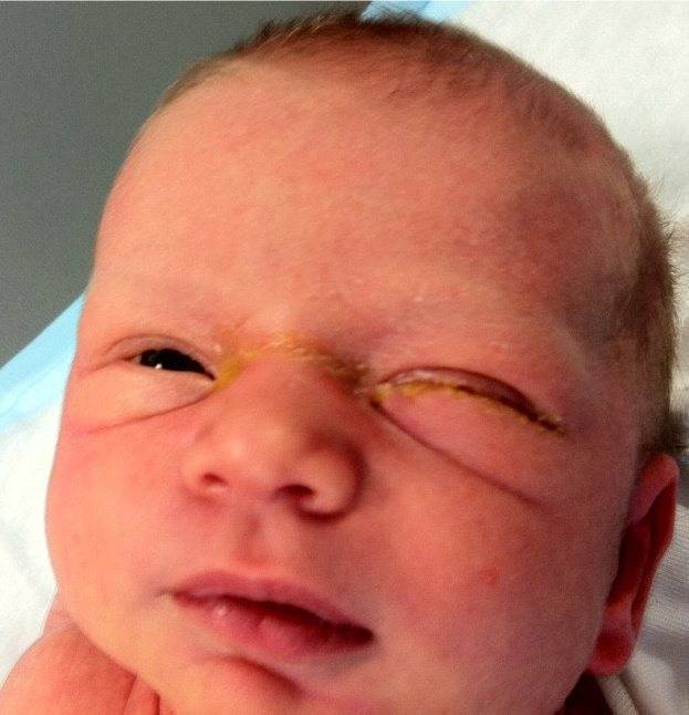 Гноится глазик у новорожденного ребенка: что делать, чем лечить гной в глазках у грудничка / mama66.ru