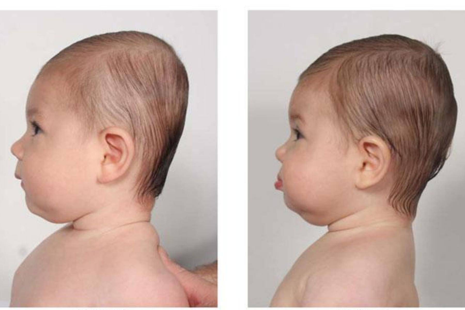 Плагиоцефалия у ребенка – неправильная форма черепа у грудничка