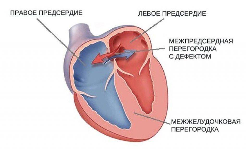 Открытое овальное окно в сердце ???? у ребенка: что это такое, когда оно должно закрыться у грудничка?
