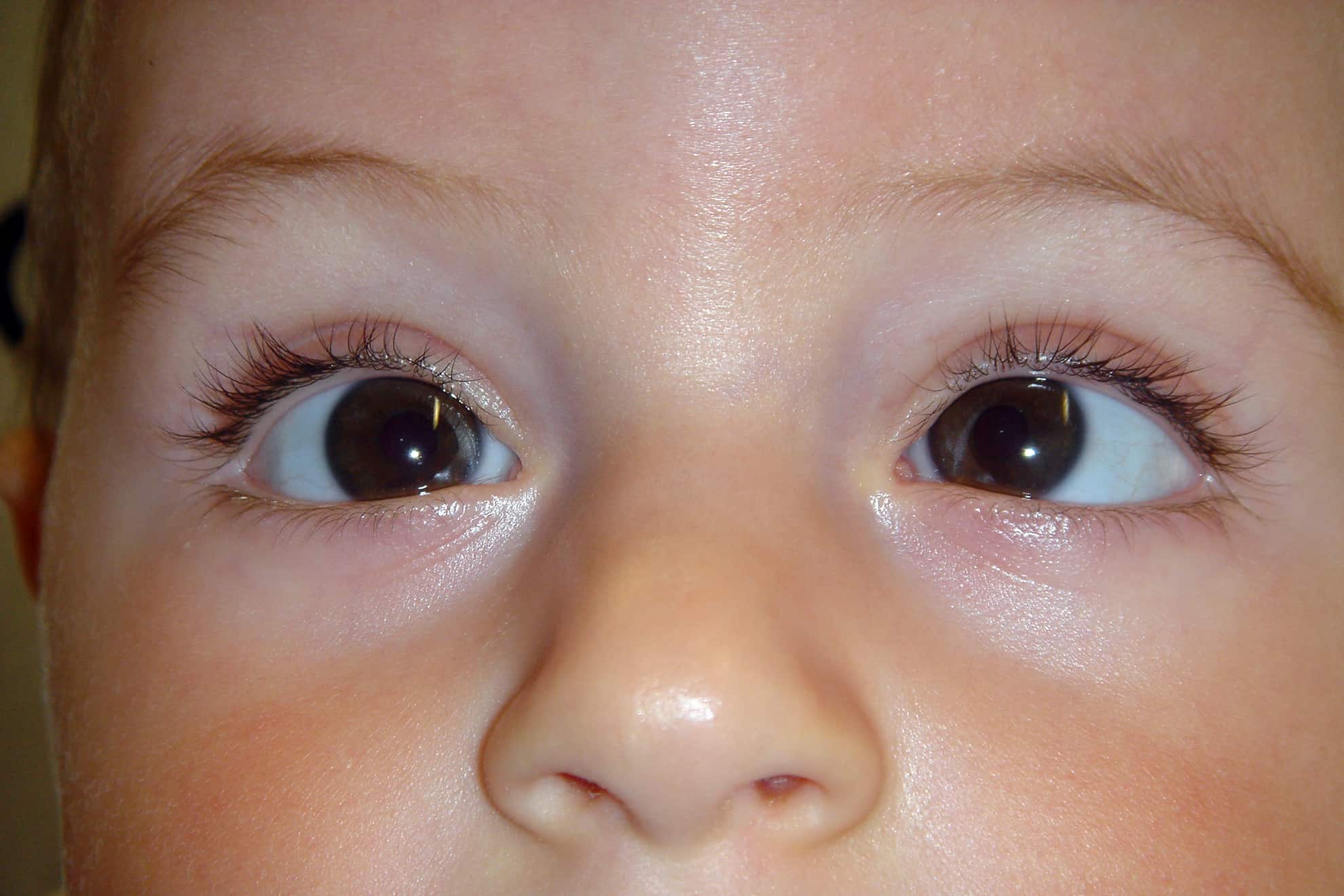 Ребенок косит глазки. Нистагм и амблиопия. Страбизм у детей. Глазные болезни косоглазие.