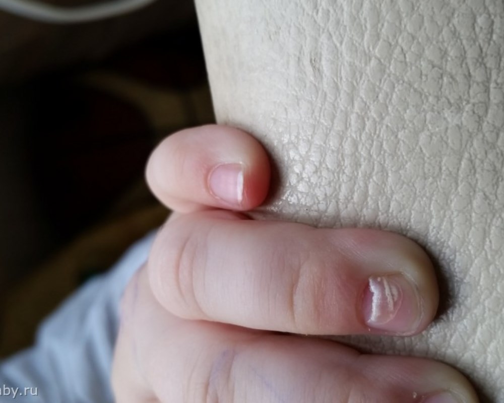 Почему слезают ногти на руках у ребенка?