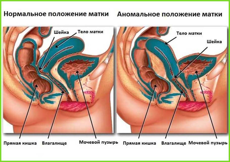 Инфантильность (гипоплазия) матки - клиника «к+31»
