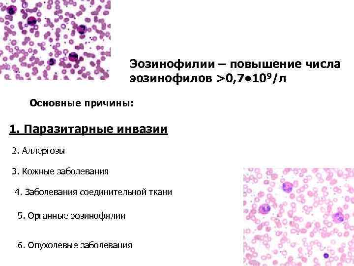 10 причин повышения уровня эозинофилов в крови у ребёнка