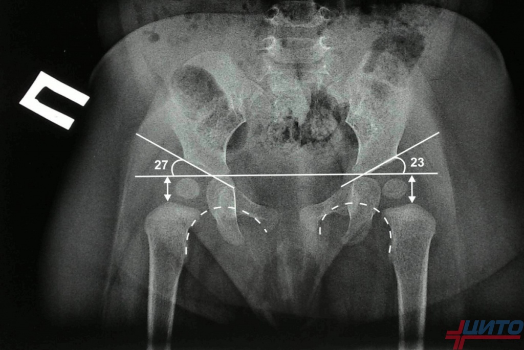 Фирмы тазобедренных суставов. Рентген тазобедренных суставов у детей норма. Дисплазия тазобедренных суставов Рент. Дисплазия тазобедренных суставов рентген.