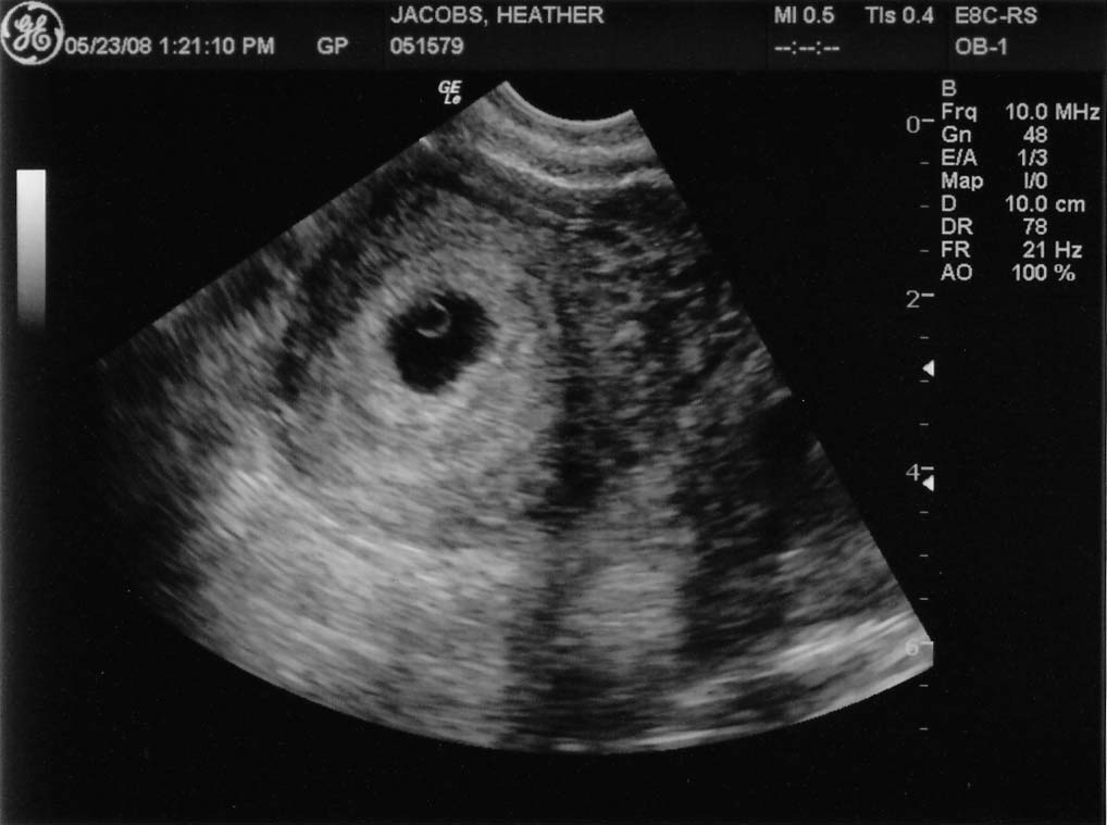 Первые 4 недели беременности. симптомы и что происходит.