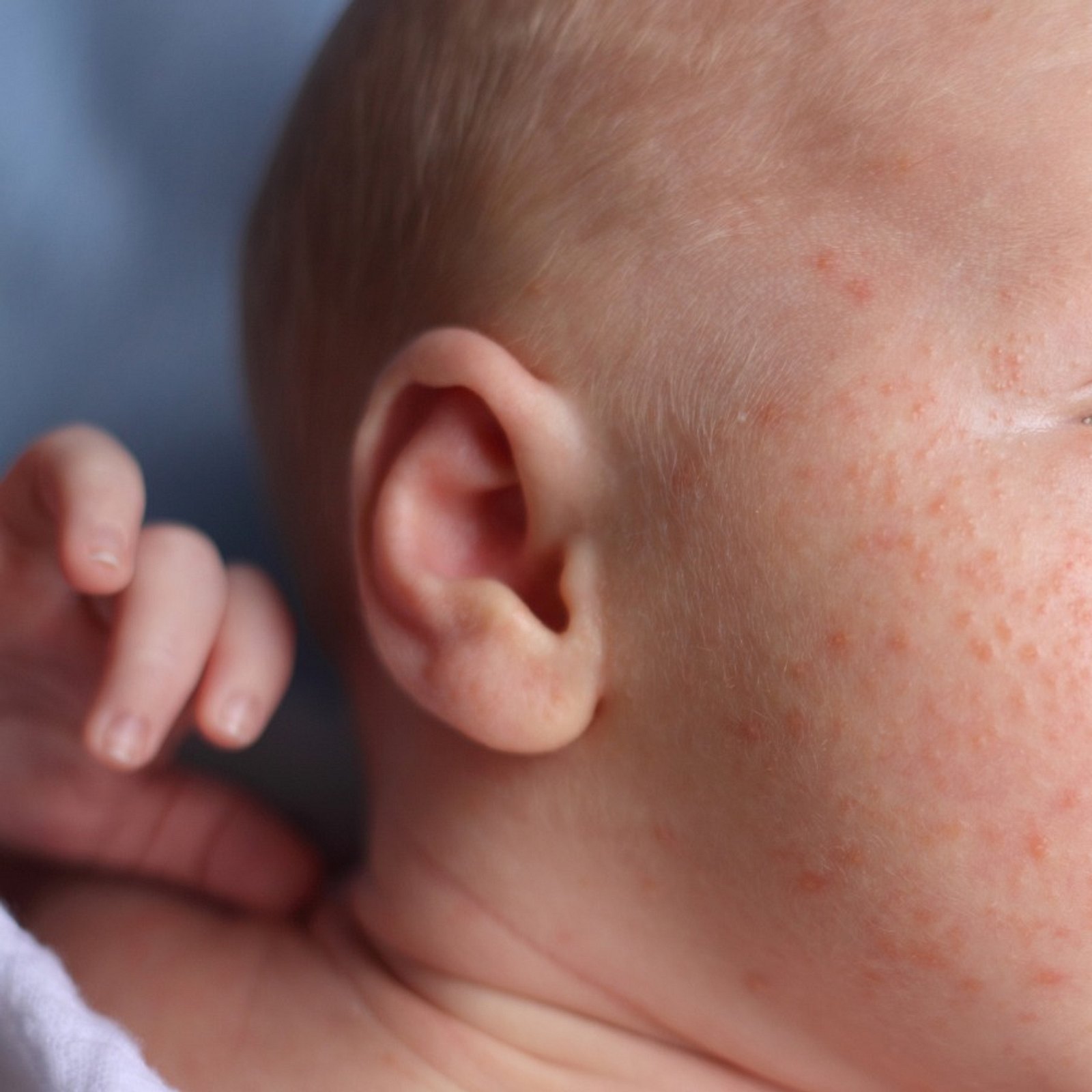 Акне у детей: как выглядит сыпь на фото, почему у новорожденного ребенка цветет кожа, чем лечить?