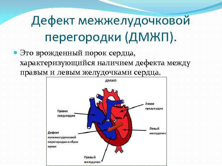 ???? дефект межжелудочковой перегородки у новорожденного в сердце - последствия и лечение мышечного дмжп