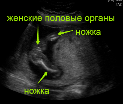 16 недель беременности можно узнать пол. УЗИ 19 недель беременности мальчик. УЗИ В 19 недель беременности фото УЗИ. УЗИ 16 недель беременности пол девочка. УЗИ пола ребенка на 19 неделе беременности.