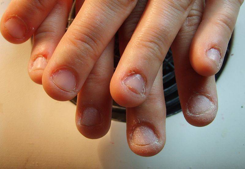 Ребенок грызет ногти: как отучить? рекомендации врачей :: syl.ru