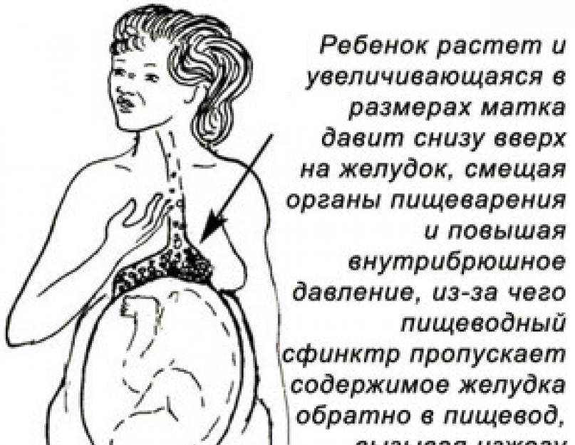 Изжога при беременности