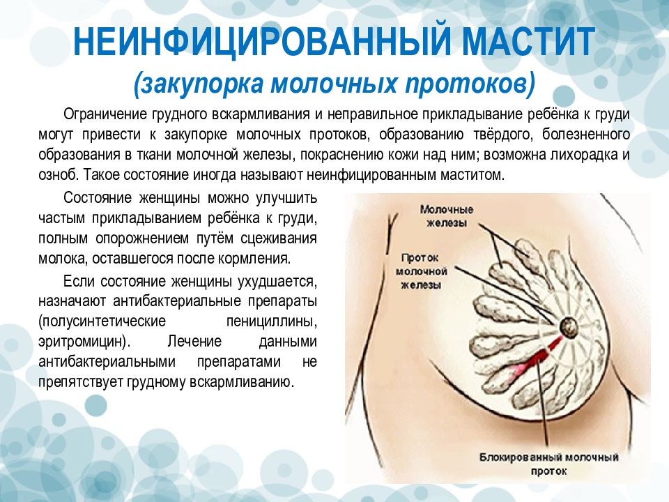 Что делать с закупоркой молочных протоков • центр гинекологии в санкт-петербурге