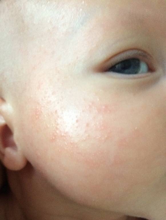 Акне у детей: как выглядит сыпь на фото, почему у новорожденного ребенка цветет кожа, чем лечить?