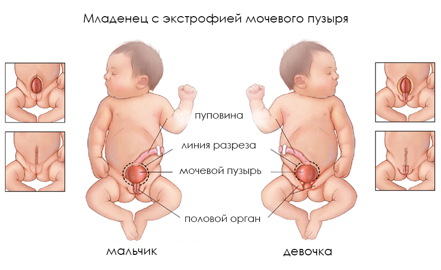 Воспаление у мальчиков крайней плоти: причины, симптомы, лечение