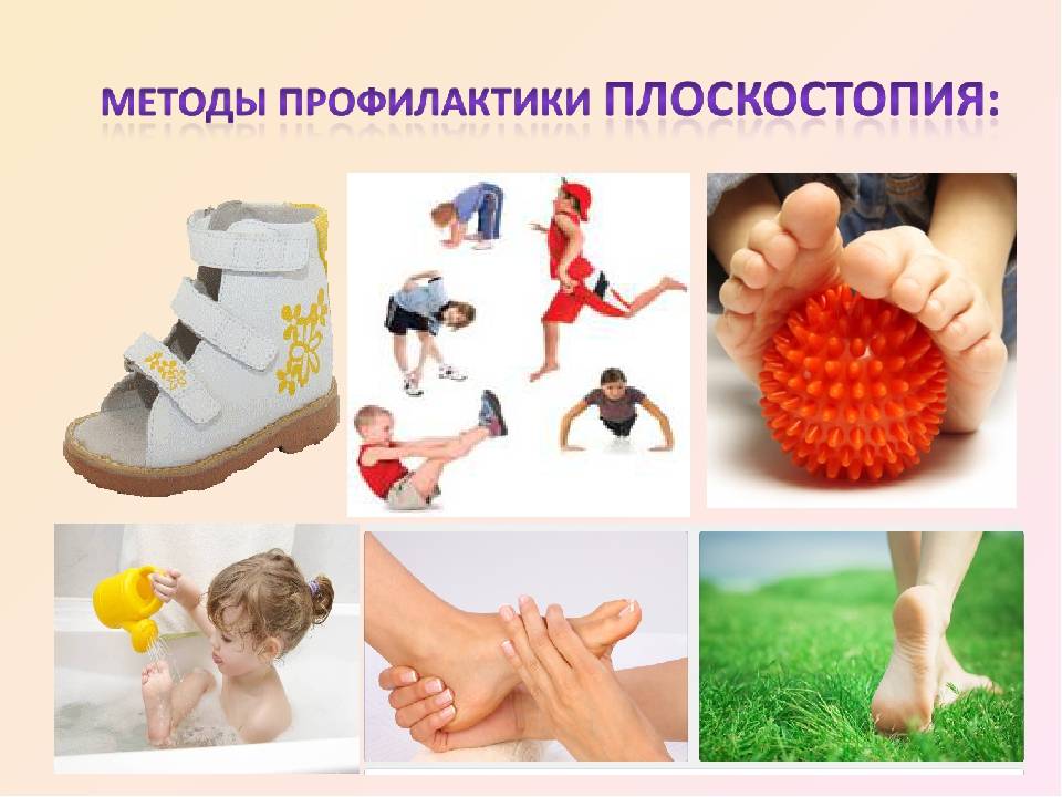 Профилактика плоскостопия у детей