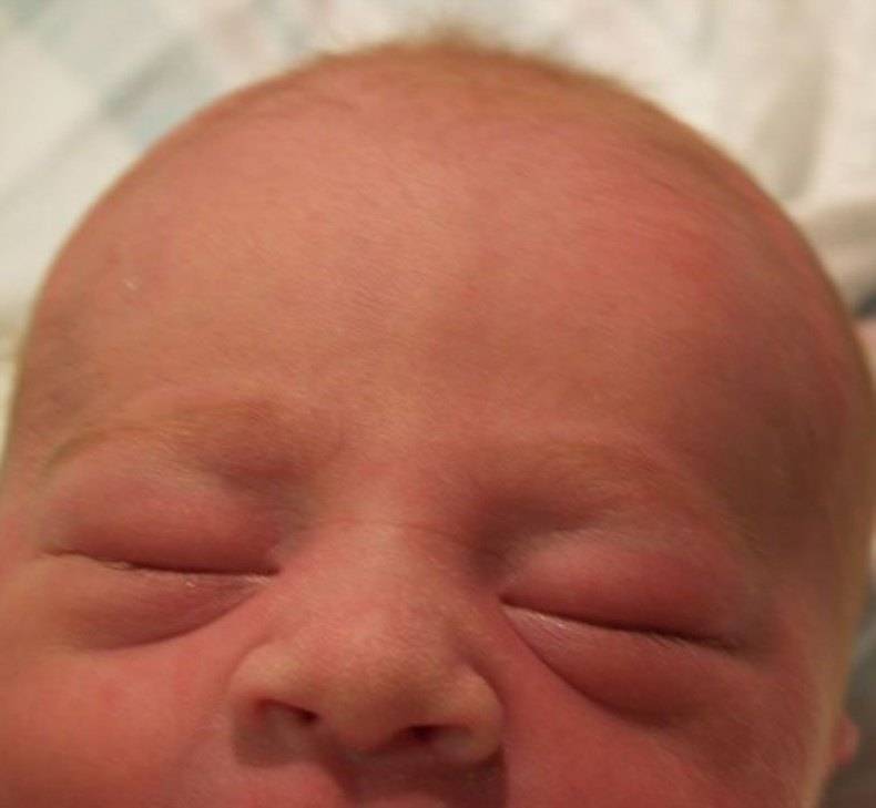 Опухшие глаза у новорожденного — в чем причины и есть ли повод для беспокойства?
