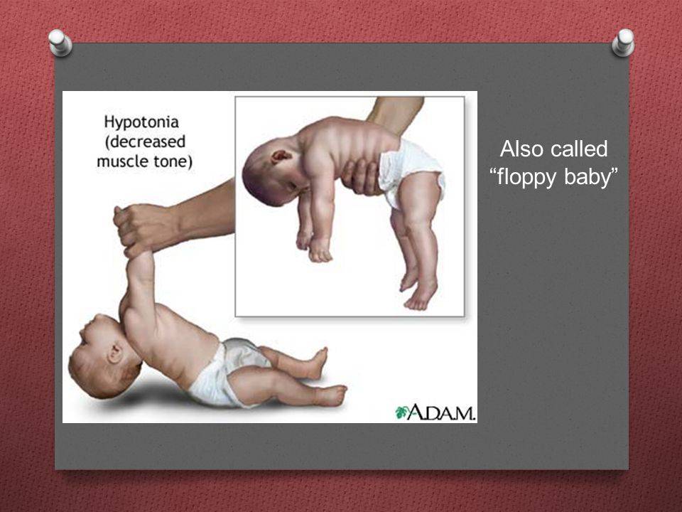 Массаж при гипертонусе или гипотонусе мышц - детский массаж в минске