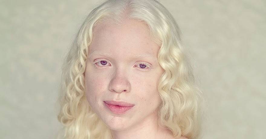 «белая ворона», или особенности здоровья и развития ребенка-альбиноса