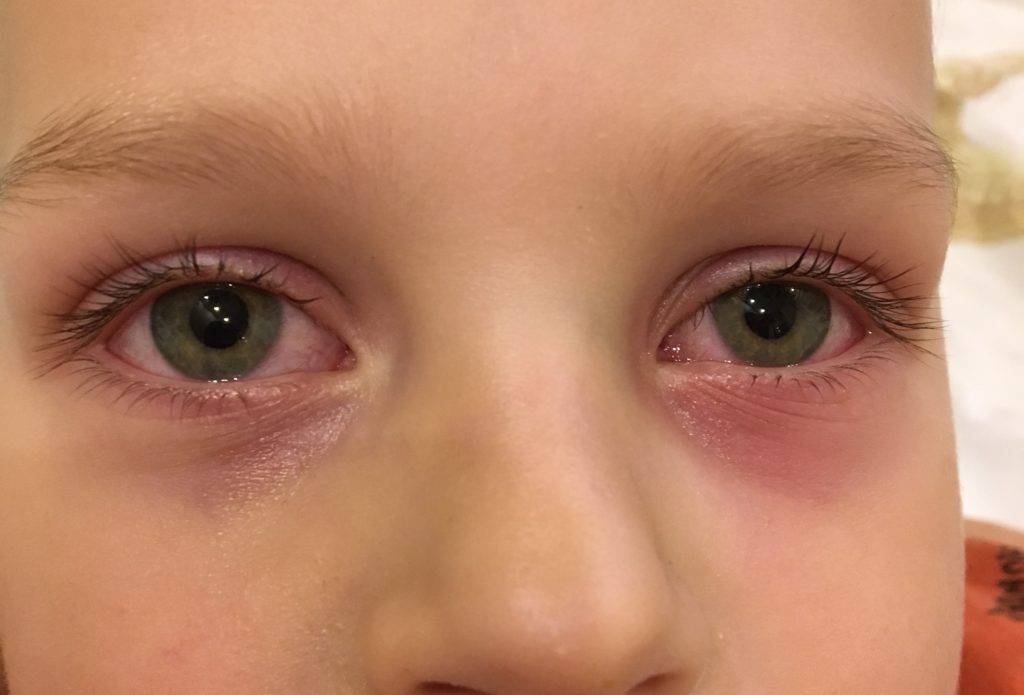 У ребенка темные круги под глазами почему - детская городская поликлиника №1 г. магнитогорска