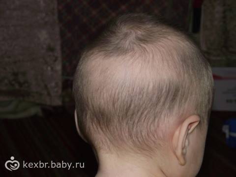 У ребенка плохо растут волосы: что делать, если они выпадают у новорожденного?