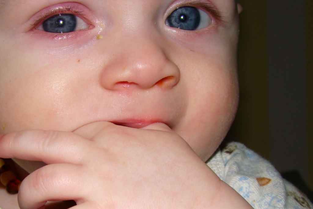 Ребенок температура слезятся глаза. Хламидийный конъюнктивит у новорожденных. Коньюктивит коньюктивит коньюктивит. Гноынйконъюнктивит новорожденных. Гонококковый конъюнктивит.