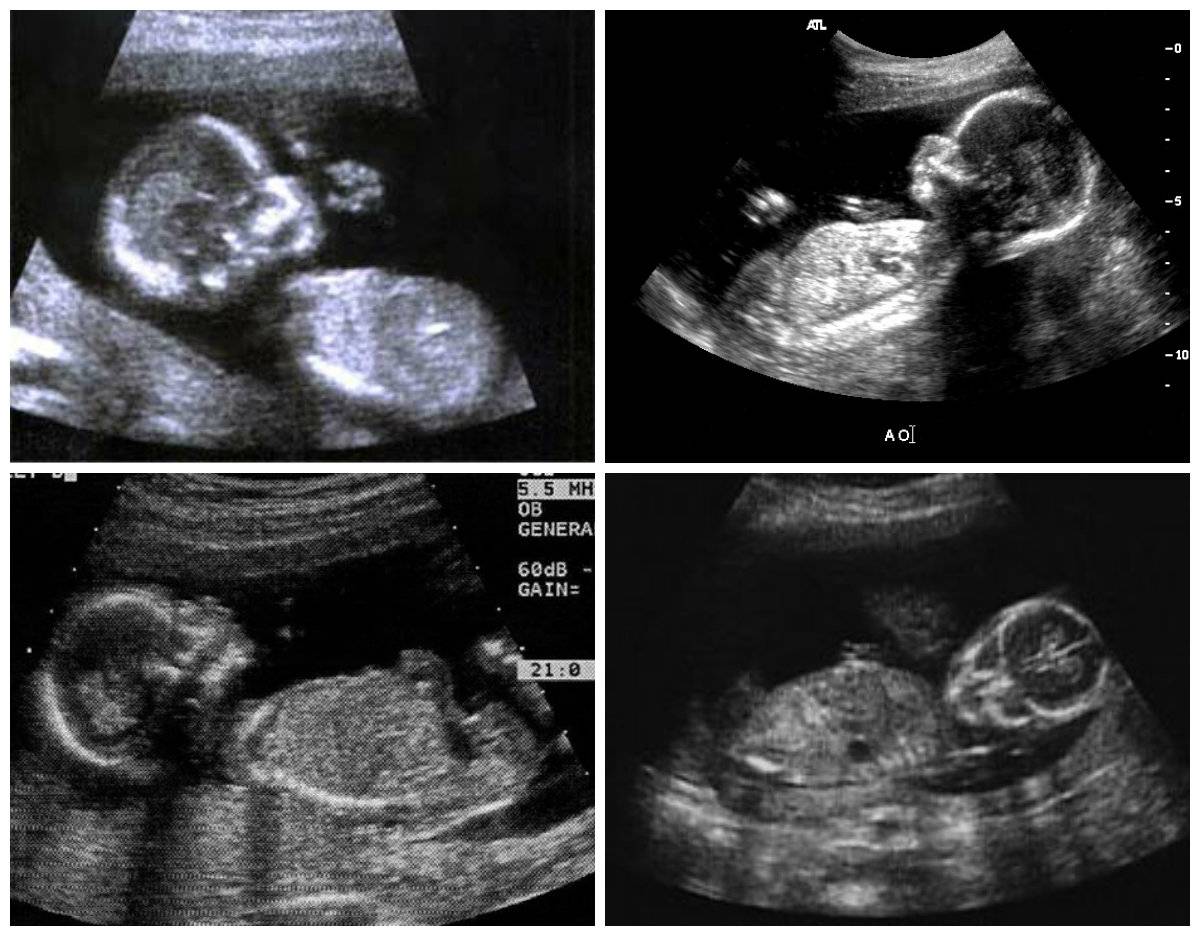 18 неделя беременности: что происходит, фото живота ожидающих девочек