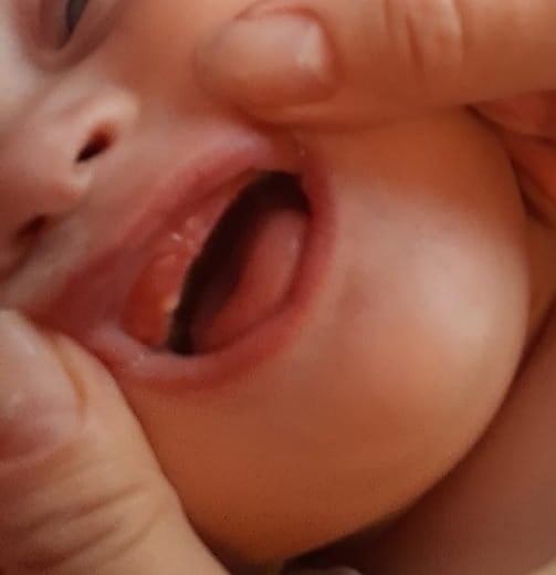 У ребенка начали резаться первые зубы: симптомы с фото у младенцев до года