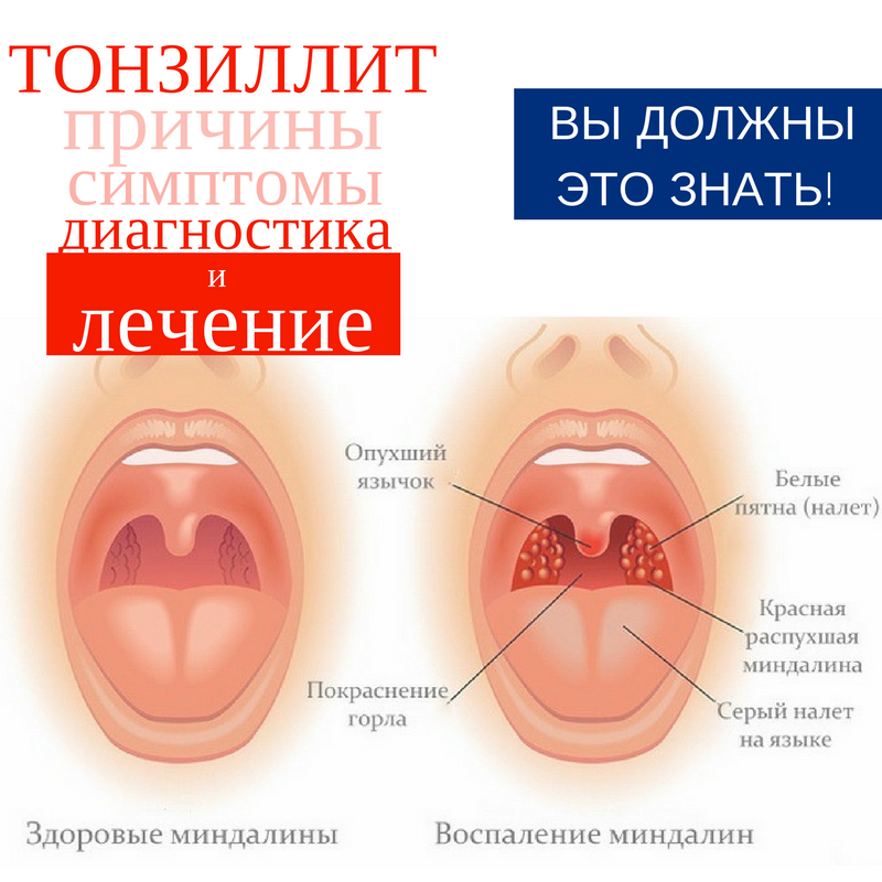 Фолликулярная ангина карта вызова. Бактериальный тонзиллит на миндалинах. Хронический тонзиллит симптомы. Гнойное воспаление миндалин.