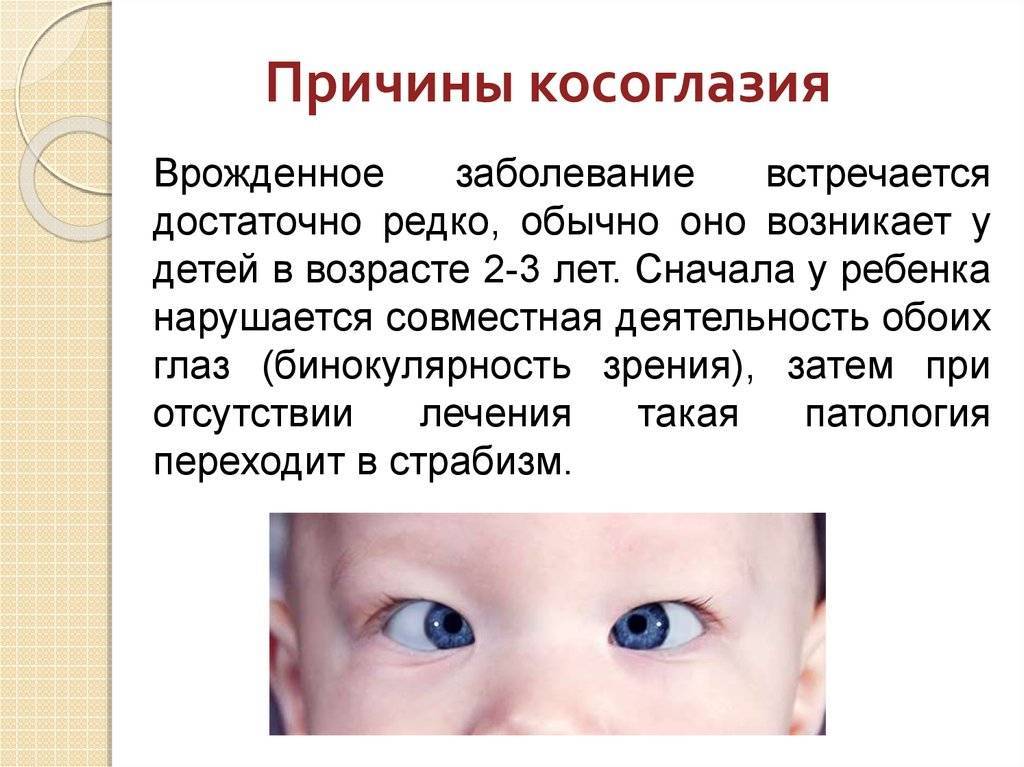 Косоглазие у детей до года: что надо знать о причинах, как определить аномалию и как ее исправить (лечение) - moscoweyes.ru - сайт офтальмологического центра "мгк-диагностик"