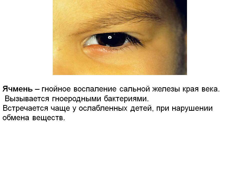 Ячмень у детей - причины и как лечить ячмень верхнего или нижнего века у ребенка - moscoweyes.ru - сайт офтальмологического центра "мгк-диагностик"